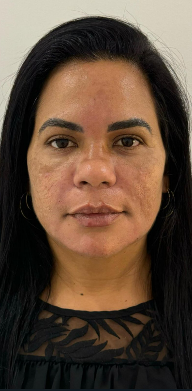 Depois do procedimento