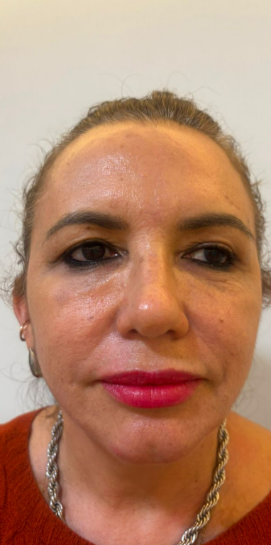 Depois do procedimento